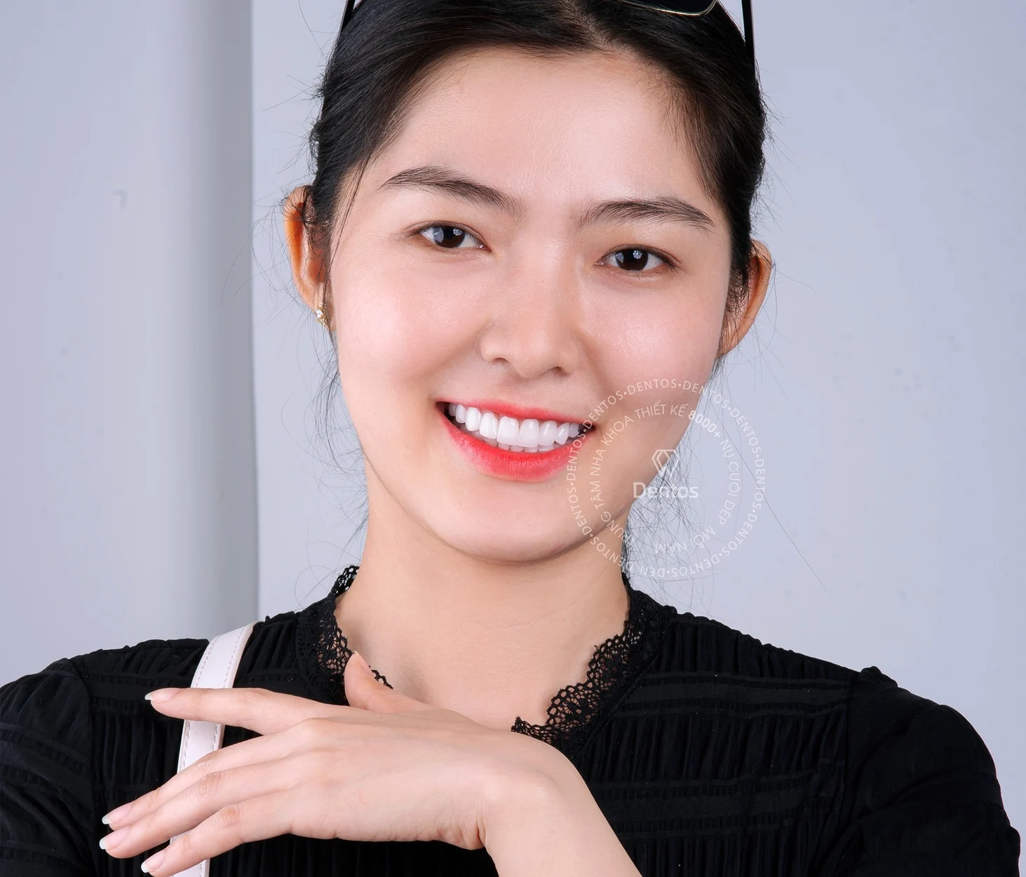 Răng sứ Orodent giá bao nhiêu? Bảng giá 2025 & Đánh giá chi tiết